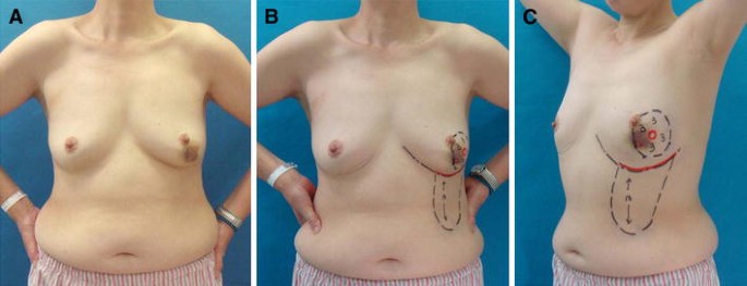 Immediate reconstruction using a modified inframammary adipofascial flap  after partial mastectomy | SpringerLink