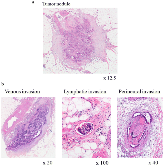 Verification Of The Japanese Staging System For Rectal Cancer Focusing On Differences With The Tnm Classification Springerlink Verification Of The Japanese Staging System For Rectal Cancer Focusing On Differences With The Tnm Classification Springerlink