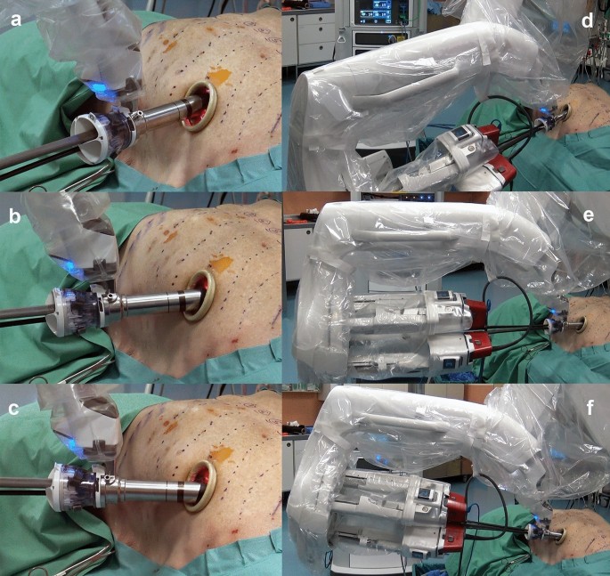 Feasibility Of Bilateral Internal Thoracic Artery Harvesting Using The Da Vinci Sp System Springerlink Feasibility Of Bilateral Internal Thoracic Artery Harvesting Using The Da Vinci Sp System Springerlink