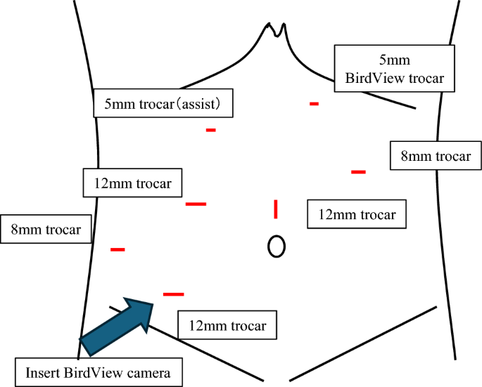 Ccpp Birdview A prospective study on the enhancement of surgical safety in robotic ...