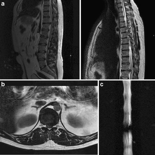 Two Brothers With A Symptomatic Thoracic Disc Herniation At T11 T12 Clinical Report Springerlink