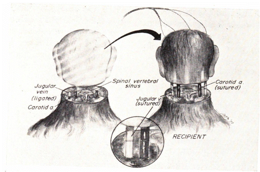 The history of head transplantation: a review | SpringerLink