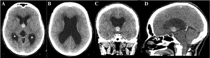 Third Ventricle Enterogenous Cyst Presentation Mimicking A Colloid Cyst Uncommon Presentation Of A Rare Disease And Literature Review Springerlink Third Ventricle Enterogenous Cyst Presentation Mimicking A Colloid Cyst Uncommon Presentation Of A Rare Disease And Literature Review Springerlink