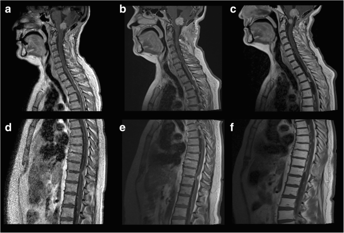 Disseminated central nervous system hemangioblastoma in a patient with no  clinical or genetic evidence of von Hippel-Lindau disease—a case report and  literature review | SpringerLink