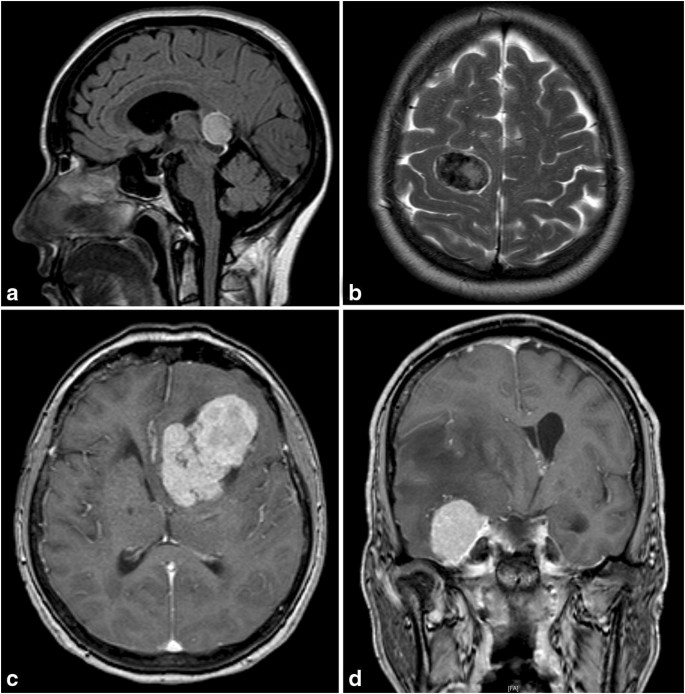 Clinical, radiological, and histopathological predictors for long-term  prognosis after surgery for atypical meningiomas | SpringerLink