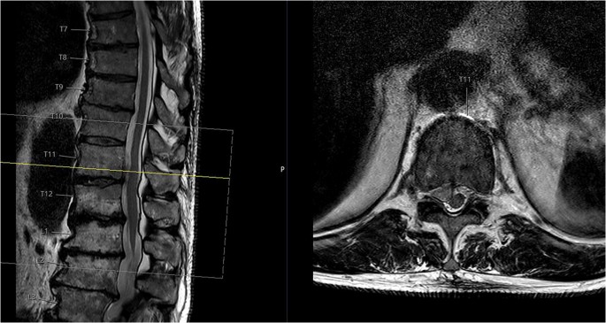 Bilateral Thoracic Disc Herniation With Abdominal Wall Paresis A Case Report Springerlink