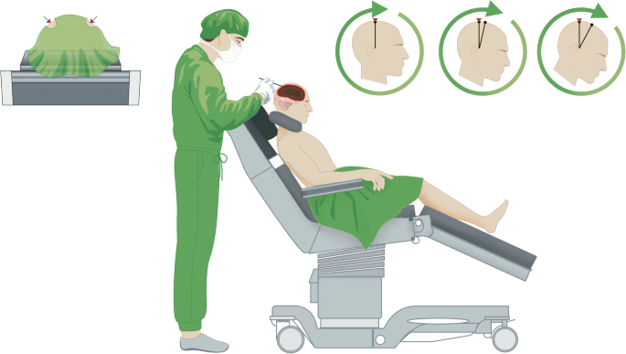 Awake Surgery In Sitting Position For Chronic Subdural Hematoma Springerlink Awake Surgery In Sitting Position For Chronic Subdural Hematoma Springerlink