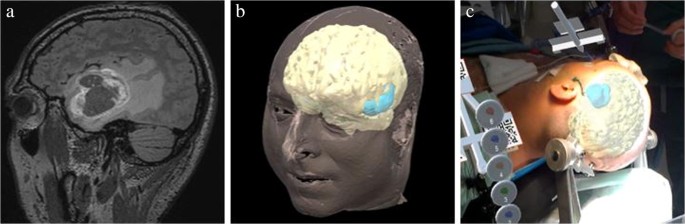 Holographic patient tracking after bed movement for augmented reality  neuronavigation using a head-mounted display | Acta Neurochirurgica