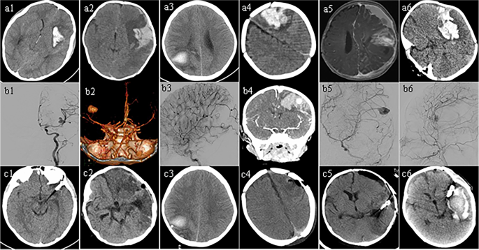 Demographic and clinical data for 23 patients with intracranial aneurysm