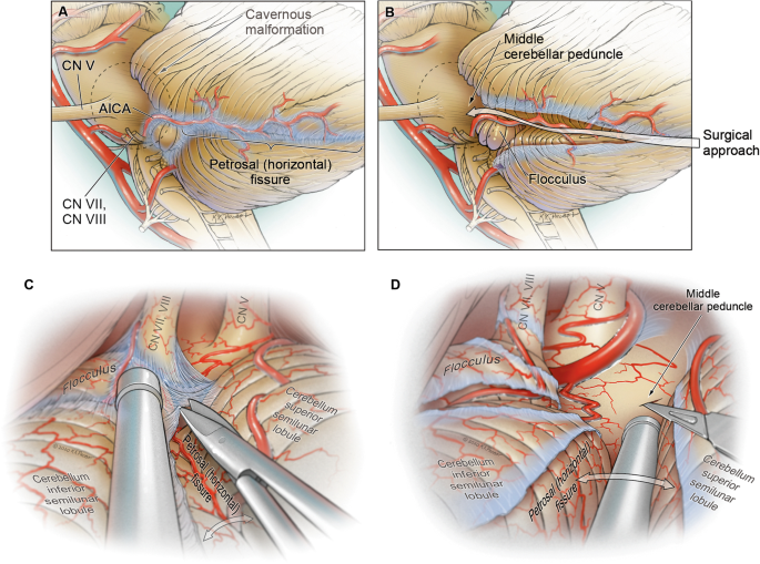 How I do it: horizontal fissure approach to the middle cerebellar peduncle  | SpringerLink