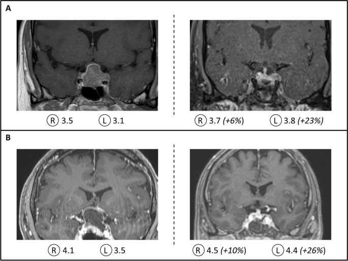 The use of quantitative pupillometry in patients with pituitary tumors: a  technical note | SpringerLink