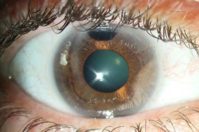 Corneal tattoo with dysphotopsia after iridotomy: worth a chance! |  SpringerLink