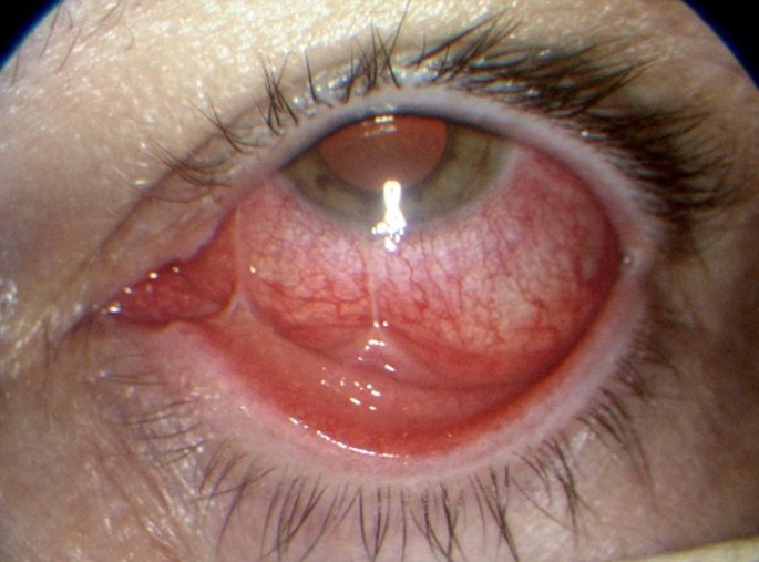Glaukom – Erkrankung der Augenoberfläche („ocular surface disease“) –  Augentropfen – Konservierungsmittel: Ein Überblick | SpringerLink