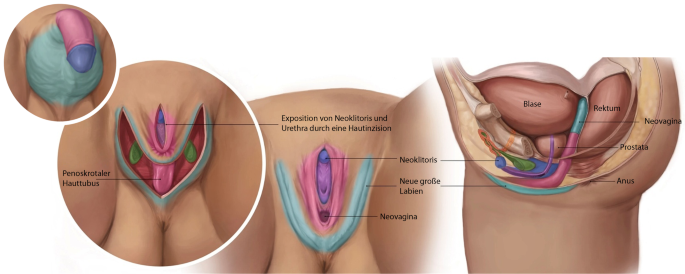 Neue Einblicke in die feminisierende genitalangleichende Chirurgie | Wiener  klinisches Magazin | Springer Nature Link