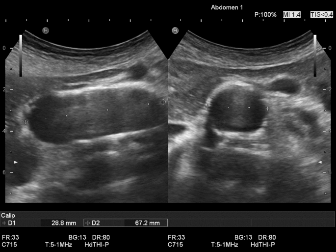 Sonographische Bestimmung des Aortenaneurysmadurchmessers | SpringerLink