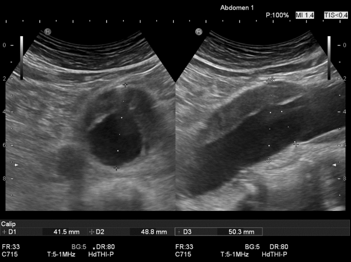 Sonographische Bestimmung des Aortenaneurysmadurchmessers | SpringerLink