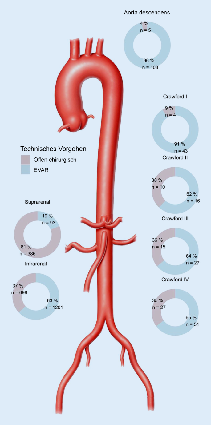 Versorgungsrealitat Von Aortenerkrankungen In Der Schweiz Springerlink