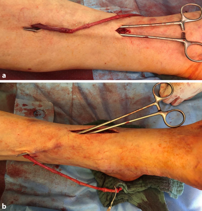 Tipps und Tricks zur erfolgreichen kruropedalen Bypasschirurgie |  Gefsschirurgie | Springer Nature Link