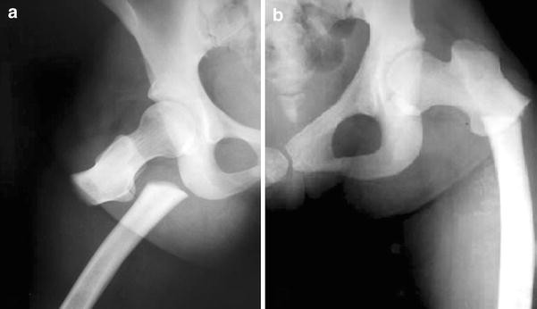 Treatment of bilateral simultaneous subtrochanteric femur fractures with  proximal femoral nail antirotation (PFNA) in a patient with osteopetrosis:  case report and review of the literature | SpringerLink