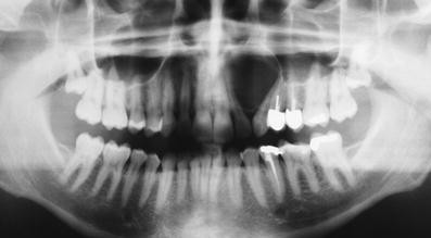 Globulomaxillary Lesion/ cyst mnemonics oral pathology nbde inbde ndeb afk oral medicine dentistry notes video mental remember grades how to pass resources how to prepare for inbde score institute coaching online courses odontologia neet pg dentista usa canada dentists license adat caapid