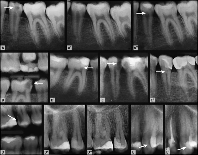 Factors affecting the outcomes of direct pulp capping using Biodentine |  SpringerLink