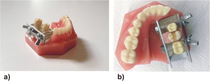 Marginal Quality Of Ceramic Inlays After Three Different Instrumental Cavity Preparation Methods Of The Proximal Boxes Springerlink