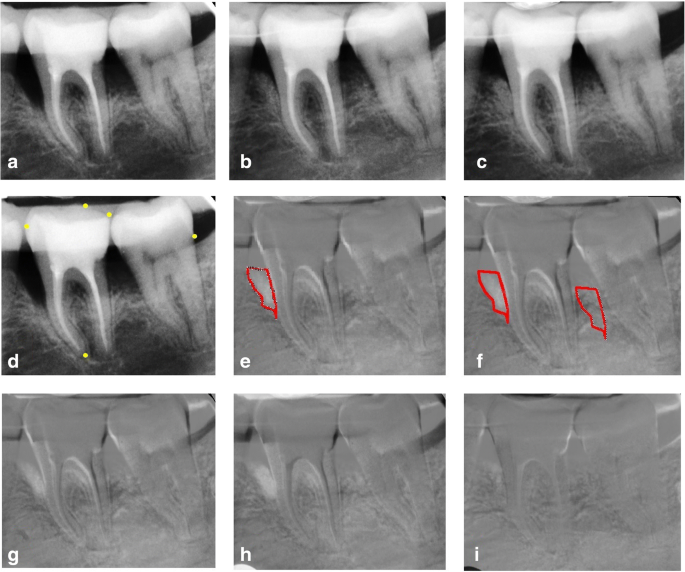 Treatment Of Intrabony Defects With Modified Perforated Membranes In Aggressive Periodontitis Subtraction Radiography Outcomes Prognostic Variables And Patient Morbidity Springerlink Treatment Of Intrabony Defects With Modified Perforated Membranes In Aggressive Periodontitis Subtraction Radiography Outcomes Prognostic Variables And Patient Morbidity Springerlink