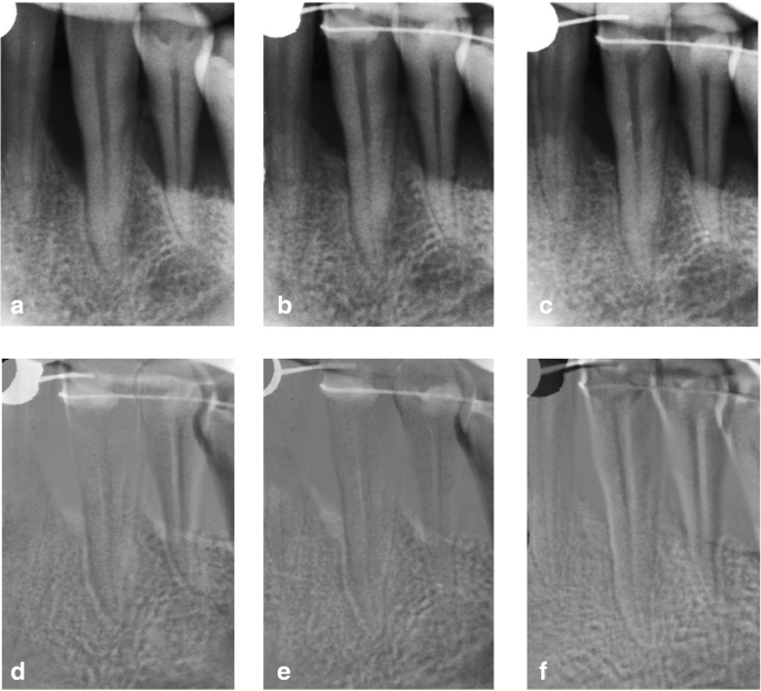 Treatment Of Intrabony Defects With Modified Perforated Membranes In Aggressive Periodontitis Subtraction Radiography Outcomes Prognostic Variables And Patient Morbidity Springerlink Treatment Of Intrabony Defects With Modified Perforated Membranes In Aggressive Periodontitis Subtraction Radiography Outcomes Prognostic Variables And Patient Morbidity Springerlink