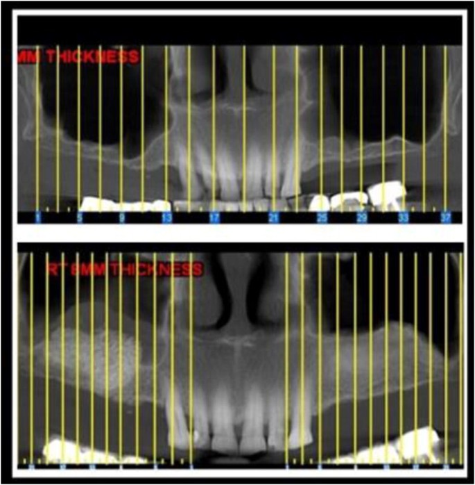 Sinus augmentation analysis of the gradient of graft consolidation ...