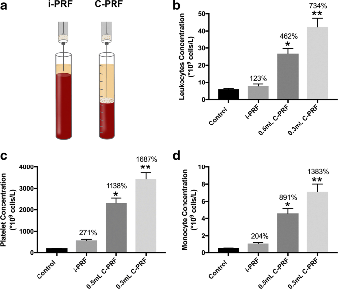 A Novel Method For Harvesting Concentrated Platelet Rich Fibrin C Prf With A 10 Fold Increase In Platelet And Leukocyte Yields Springerlink