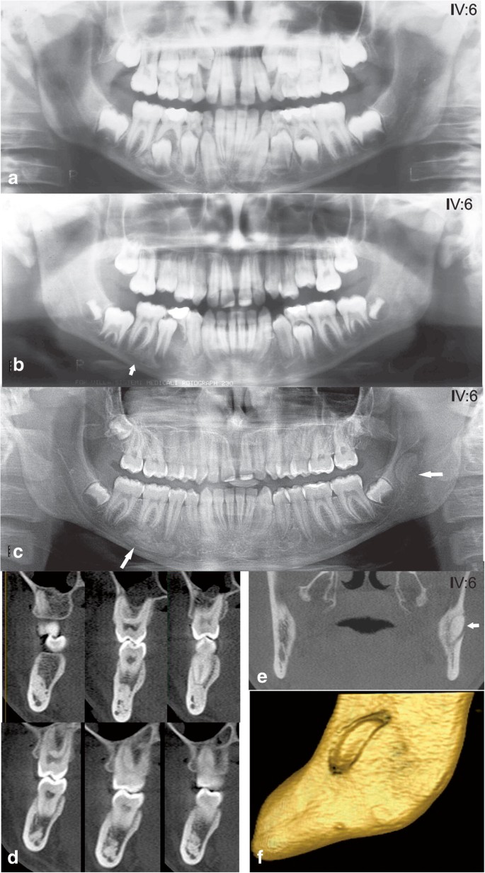Multiple odontoma in Gardner syndrome: unusual report, image size:685x1233