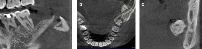 Risk factors for lingual plate fracture during mandibular third molar  extraction | SpringerLink
