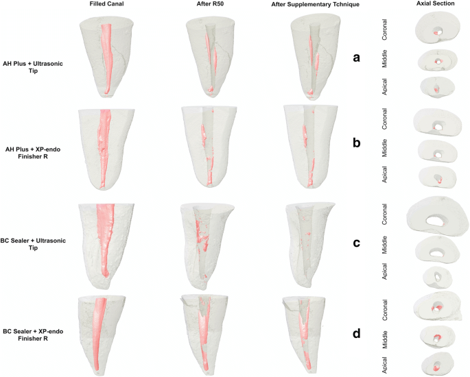 Retreatability Of Bc Sealer And Ah Plus Root Canal Sealers Using New Supplementary Instrumentation Protocol During Non Surgical Endodontic Retreatment Springerlink