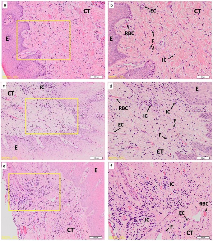 Preliminary Investigation Of The Antibacterial Efficacy Of A Handheld Plasma Gun Source For Endodontic Procedures Sciencedirect