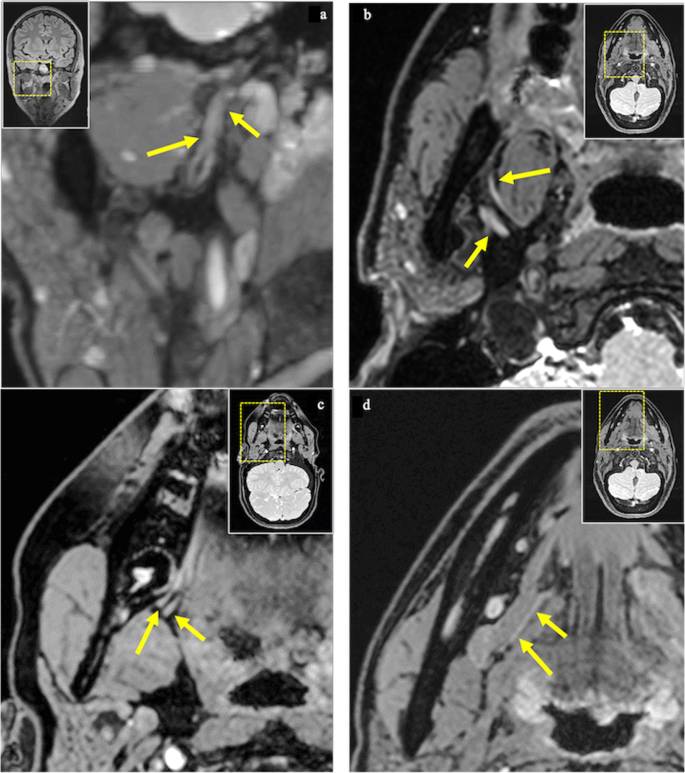 Marginal mandibular nerve, Radiology Reference Article