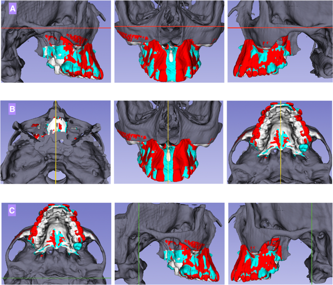 Surgically assisted rapid palatal expansion (SARPE): three-dimensional  superimposition on cranial base | SpringerLink