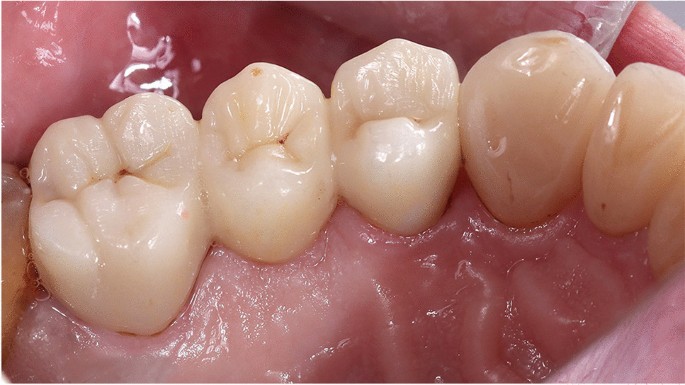 fabric I eat breakfast Transplant Randomized clinical trial comparing monolithic and veneered zirconia three-unit posterior fixed partial dentures in a complete digital flow: three-year follow-up | SpringerLink fabric I eat breakfast Transplant Randomized clinical trial comparing monolithic and veneered zirconia three-unit posterior fixed partial dentures in a complete digital flow: three-year follow-up | SpringerLink