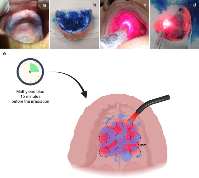 Controlling methylene blue aggregation: a more efficient alternative to  treat Candida albicans infections using photodynamic therapy -  Photochemical & Photobiological Sciences (RSC Publishing)  DOI:10.1039/C8PP00238J