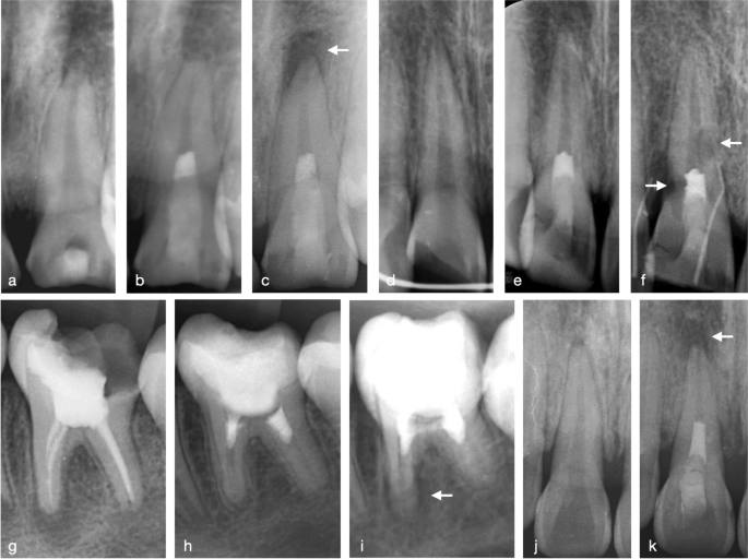 A) Preoperative periapical radiograph of tooth #21. Note the