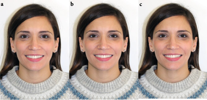 Face Inclination Model Influence of facial pattern on the aesthetic assessment of the ...