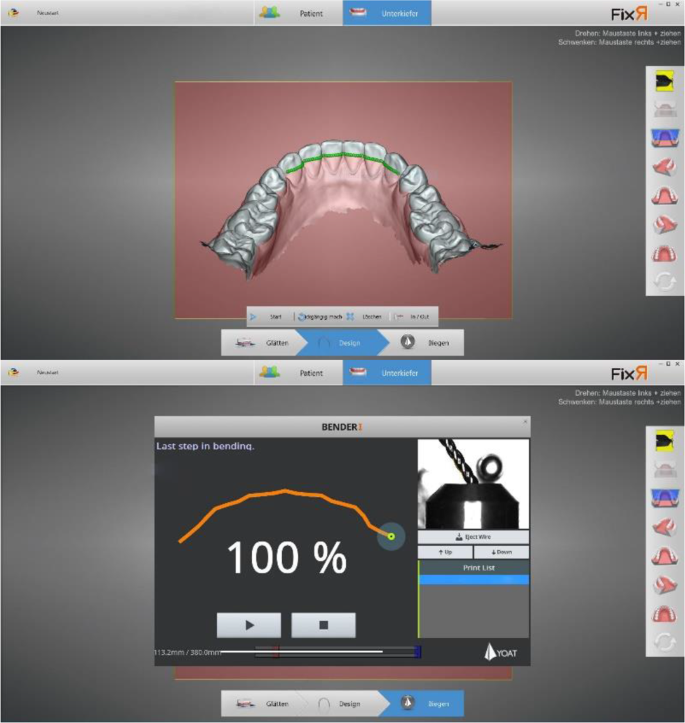 Post-treatment stability after insertion of CAD/CAM fabricated or ...