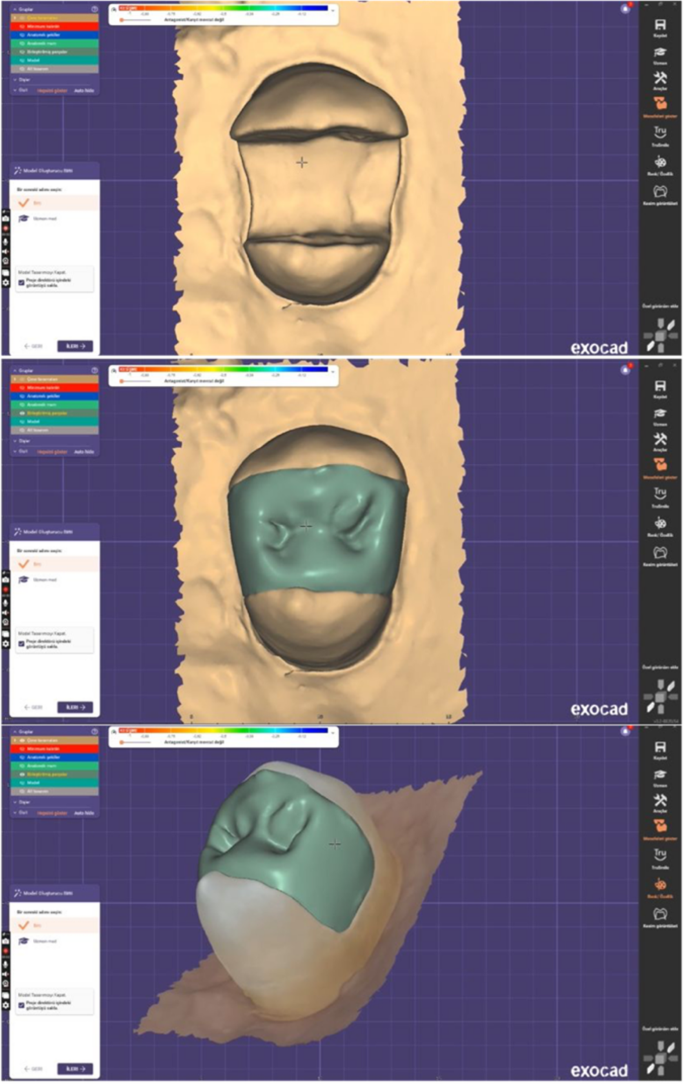 Comparative evaluation of fracture resistance of endodontically treated ...