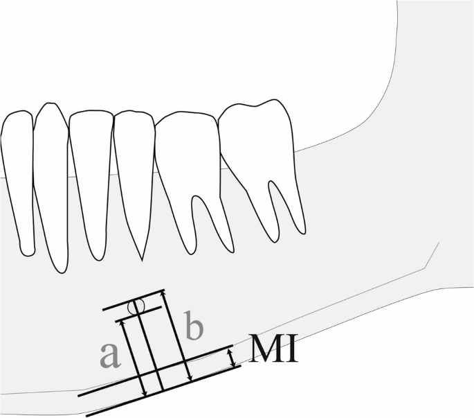 Genetic and epidemiologic assessment of mandibular cortical indices and ...