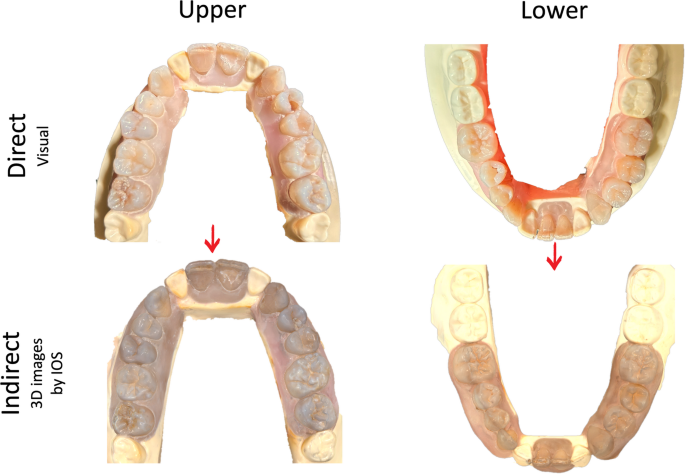 3D intraoral scanner as an auxiliary tool for the diagnosis of dental ...