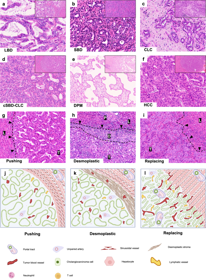 Histopathological growth pattern and vessel co-option in intrahepatic ...