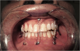 A comparative study of intermaxillary fixation screws and noncompression  miniplates in the treatment of mandibular fractures: a prospective clinical  study | SpringerLink