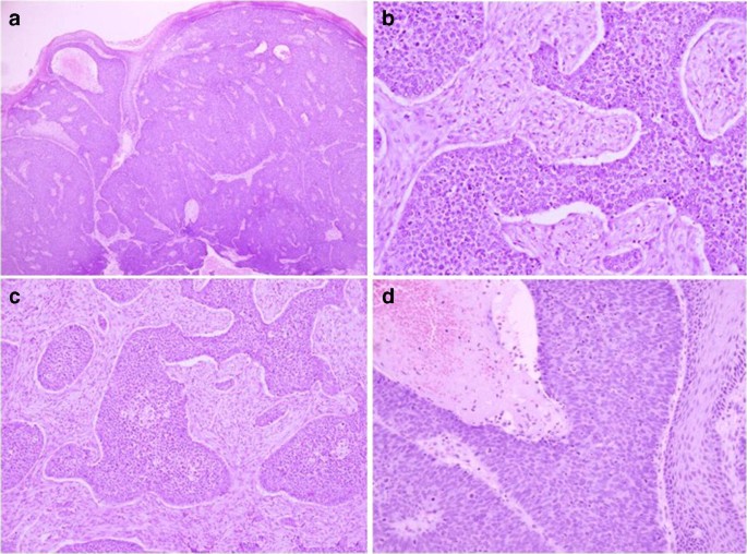 Basaloid Squamous Cell Carcinoma A 31 Year Retrospective Study And Analysis Of 214 Cases Reported In The Literature Springerlink