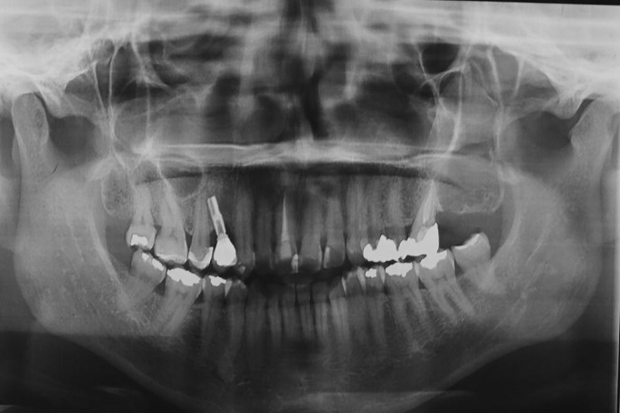 ameloblastoma x ray