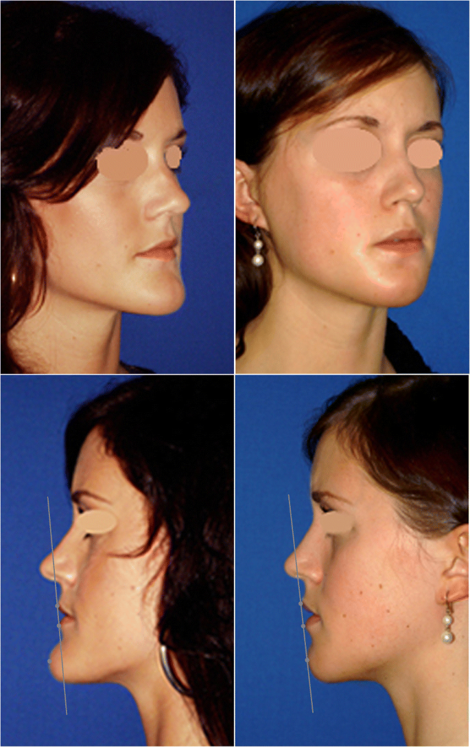 Reduction genioplasty for mandibular prognathism and long chin |  SpringerLink