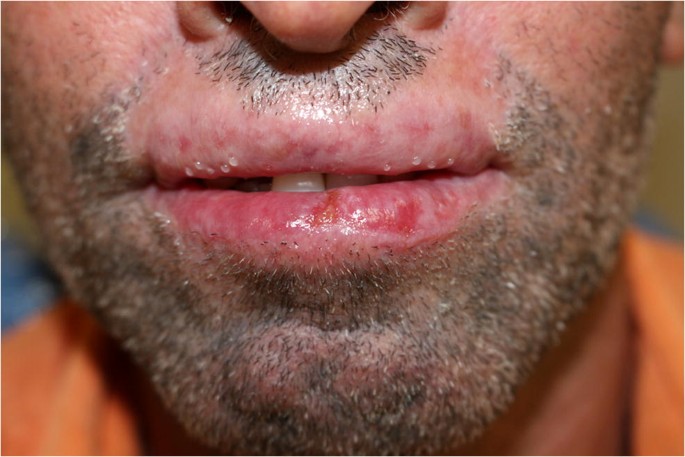 Co-existence of cheilitis glandularis and actinic cheilitis—an update |  SpringerLink